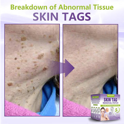 ✅NESLEMY® Soluble Microneedle Botanical Skin Tag Removal Patch