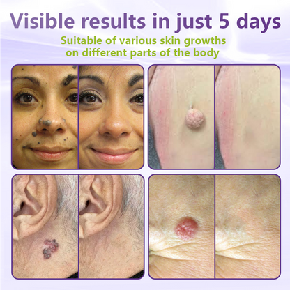 ✅NESLEMY® Soluble Microneedle Botanical Skin Tag Removal Patch