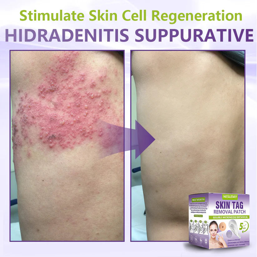 ✅NESLEMY® Soluble Microneedle Botanical Skin Tag Removal Patch
