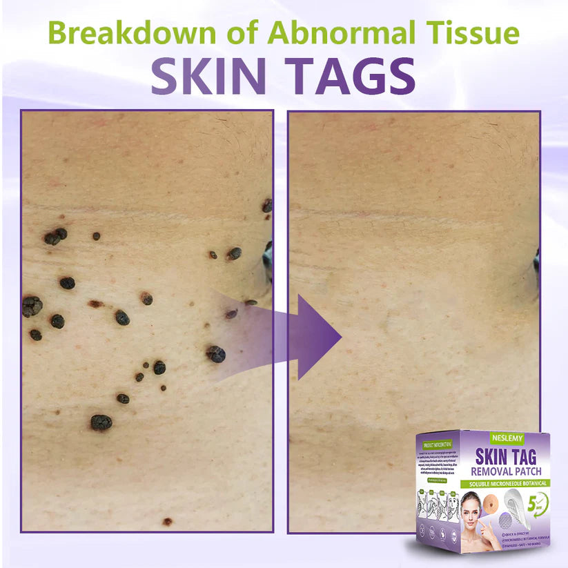 ✅NESLEMY® Soluble Microneedle Botanical Skin Tag Removal Patch