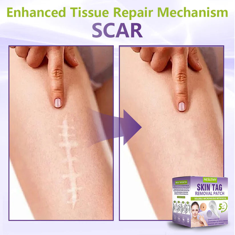 ✅NESLEMY® Soluble Microneedle Botanical Skin Tag Removal Patch