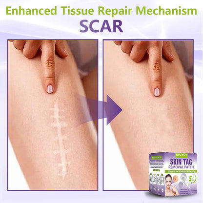✅NESLEMY® Soluble Microneedle Botanical Skin Tag Removal Patch