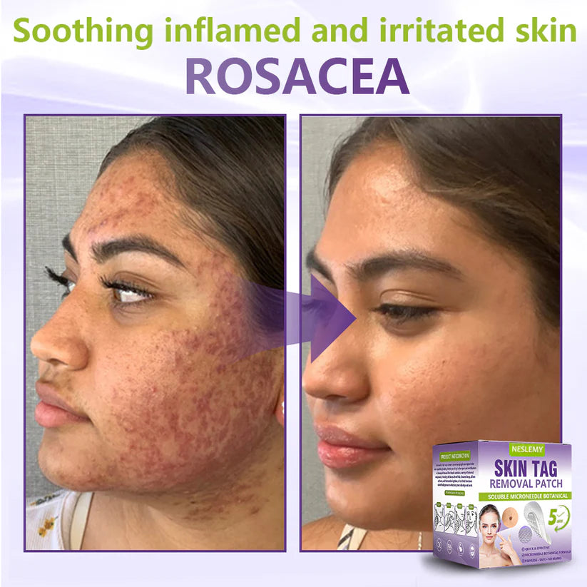 ✅NESLEMY® Soluble Microneedle Botanical Skin Tag Removal Patch